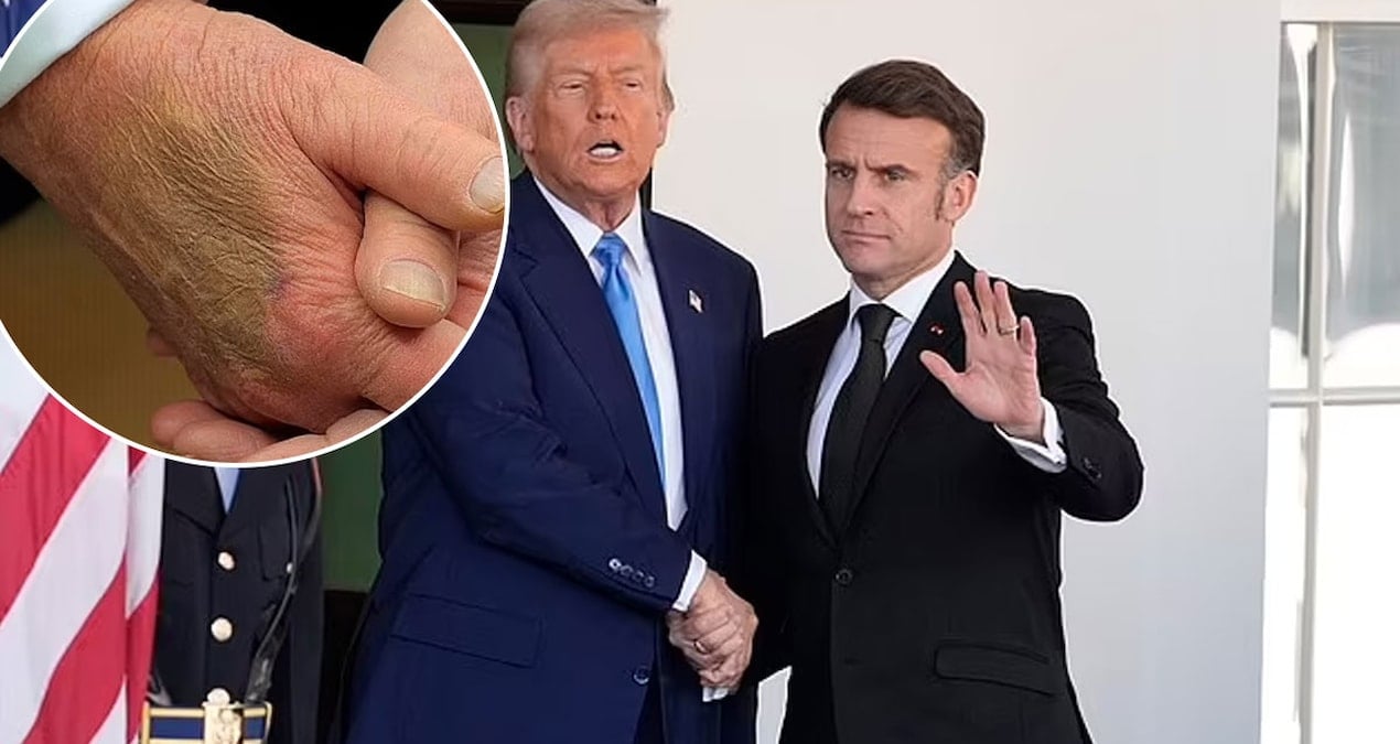 Trump’ın elindeki morluk dikkat çekti: Sağlığıyla ilgili ne saklanıyor?